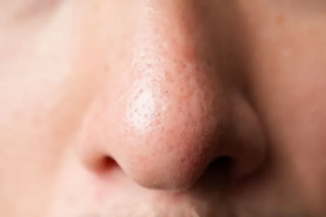いちご鼻にさようなら！おすすめのエステで毛穴ケアを本気で始めよう